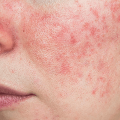 Rosacea-dermahouse-maasmechelen